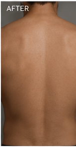 Clearer back after using RAVN, subject 3